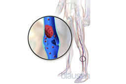 Why Blood Clots in the legs can be fatal - SLUCare Health Watch 