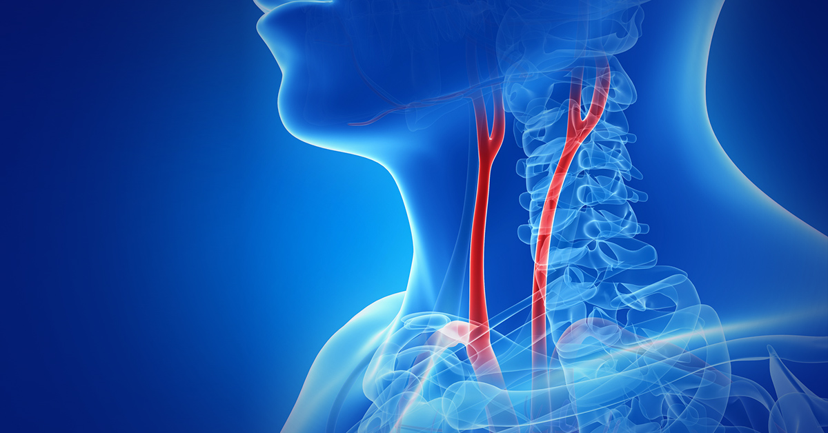 Carotid Artery Stenting Cas Surgery Medstar Health